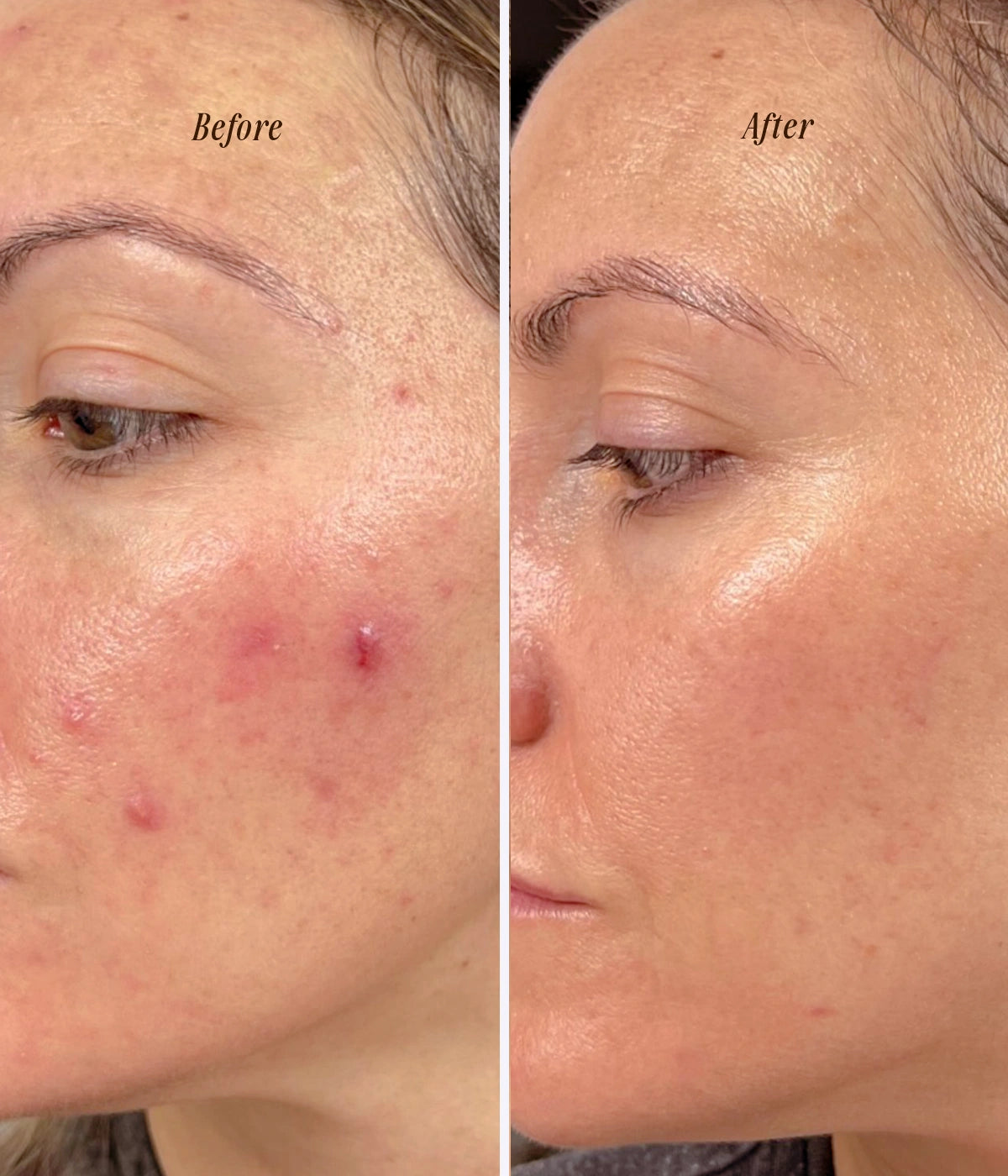 Image of Before and after result of using natural Kansa Wand and Face Oil for skin tightening