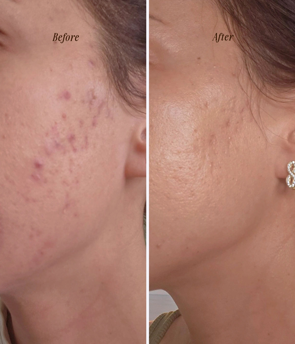 Image of Before and after result of using natural Kansa Wand and Face Oil for skin acne